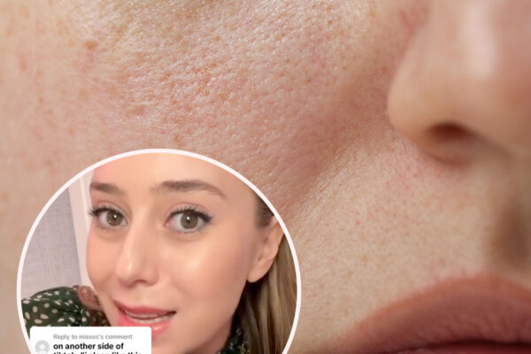 closeup of irritate skin and tiktok dermatologist ShereeneIdriss A Board-Certified Derm Explains How Using Too Much Moisturizer Can Actually Cause 'Fungus On Your Face' And Lead To An 'Inflamed Skin Barrier'