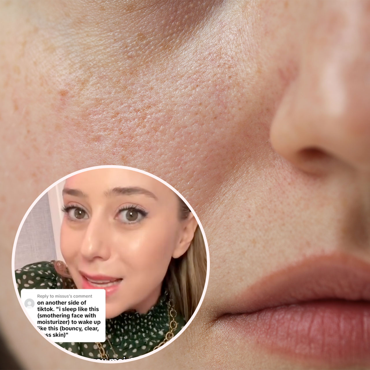 closeup of irritate skin and tiktok dermatologist ShereeneIdriss A Board-Certified Derm Explains How Using Too Much Moisturizer Can Actually Cause 'Fungus On Your Face' And Lead To An 'Inflamed Skin Barrier'